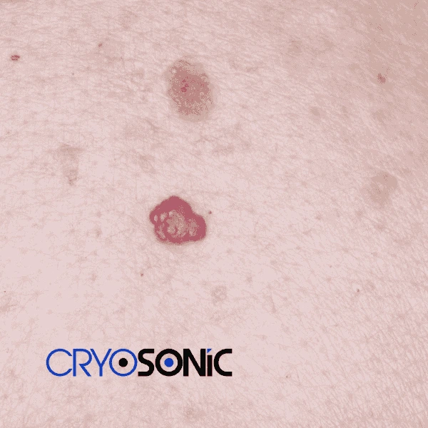 Looking for pain free cherry angioma removal treatment Coalville? Call our team today! Coalville