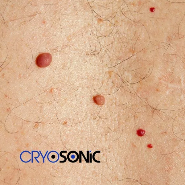 get cherry angioma removal treatment today! Coalville