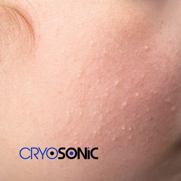 Are you looking for milia removal treatment? Contact our team today Coalville