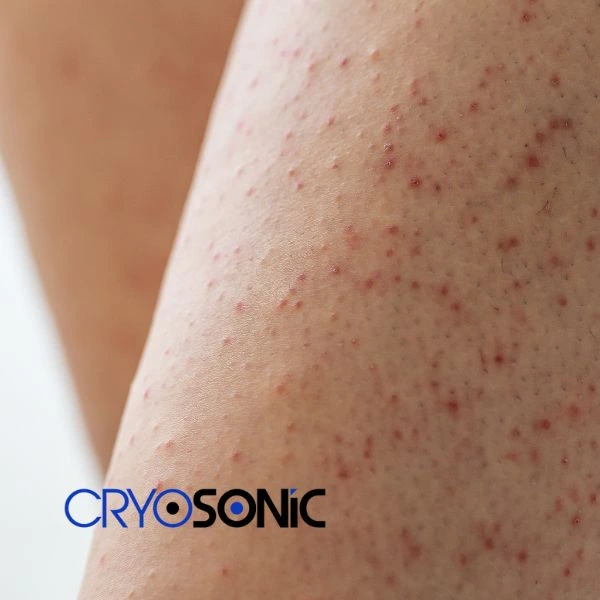 Looking for Seborrhoeic Keratosis removal Coalville treatment? Call our consultants today in Coalville