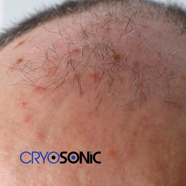 Access Seborrhoeic Keratosis removal from the comfort of your own home! Call us today in Coalville