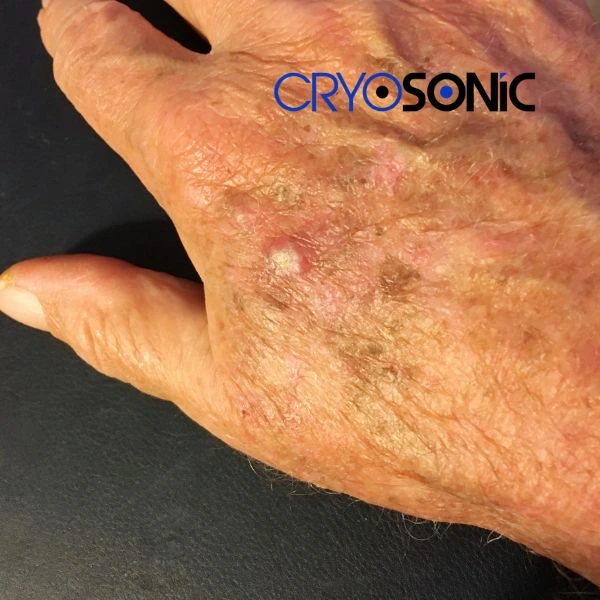 Understand more about actinic keratosis treatment today Coalville