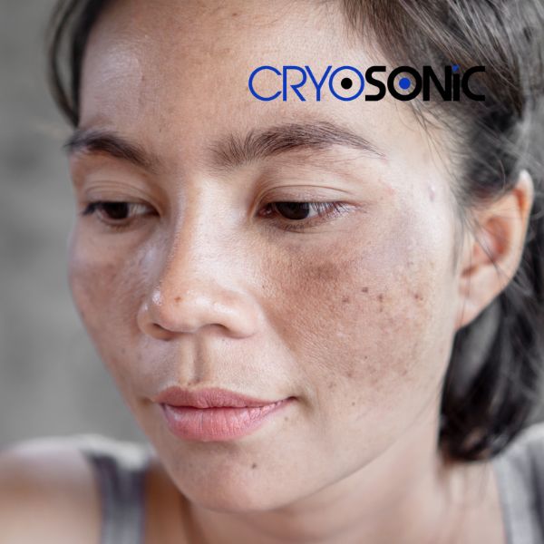 Ready to start age spots removal? Contact our team today in Coalville