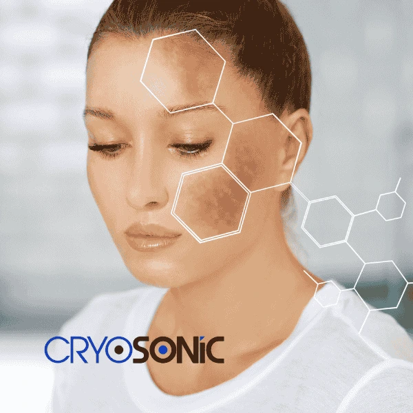 Are you looking for age spot removal treatment? Contact Cryosonic today in Coalville