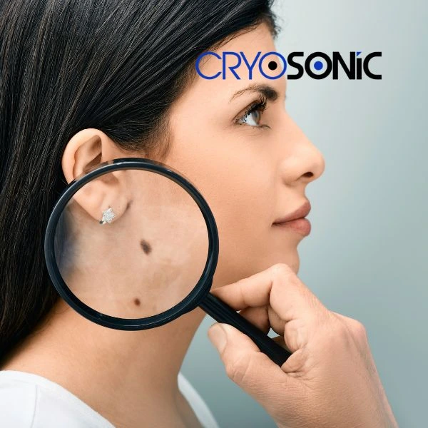Do you want to learn more about benign moles removal treatment? Call our team today Coalville
