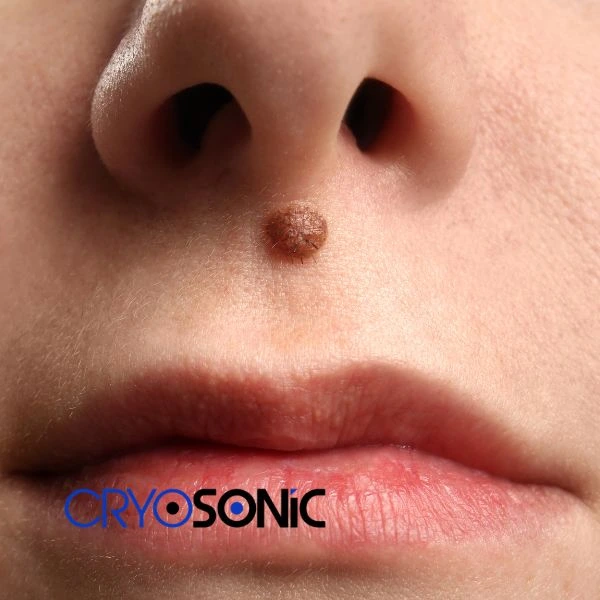 Start your benign moles removal treatment today Coalville