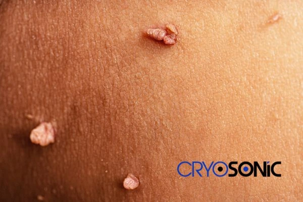 What Can You Expect During and After Your Cryosonic Treatment Coalville