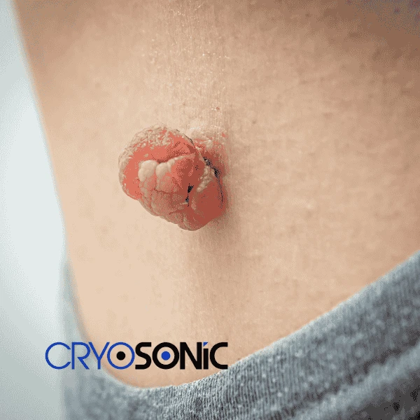 Book your skin tags removal Coalville from comfort of your own home! Coalville