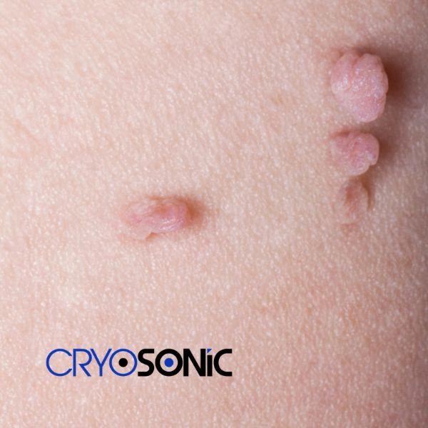 Are you looking for fast effect skin tag removal Coalville? Book in NOW! Coalville
