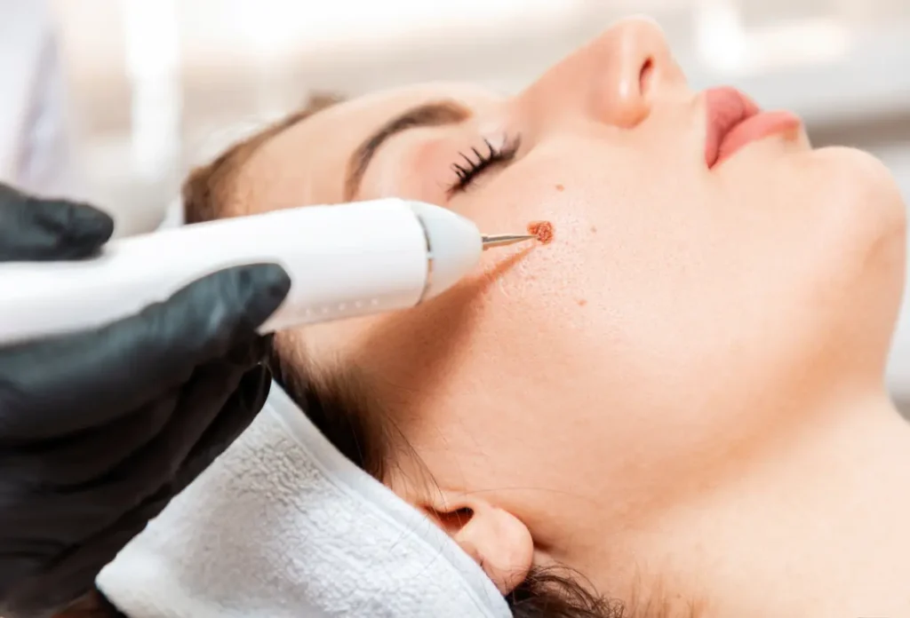 CryoPen Accuracy Coalville being used to safely and precisely remove multiple skin lesions, illustrating answers to common patient FAQs Coalville