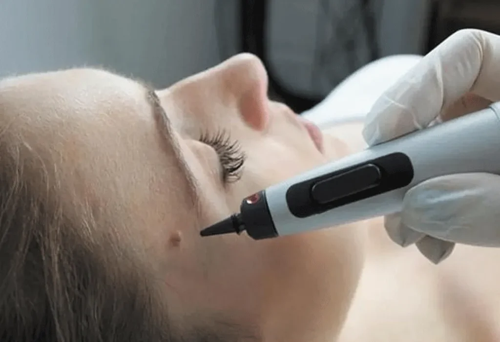 CryoPen accurately targeting skin lesions with millimetre-precision for safe and effective removal by Cryosonic Coalville