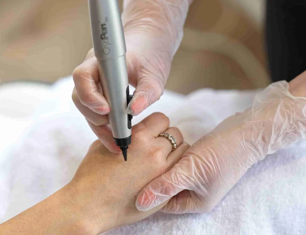 CryoPen Accuracy Coalville in action, precisely targeting a skin lesion to ensure safe treatment and protect surrounding healthy skin Coalville
