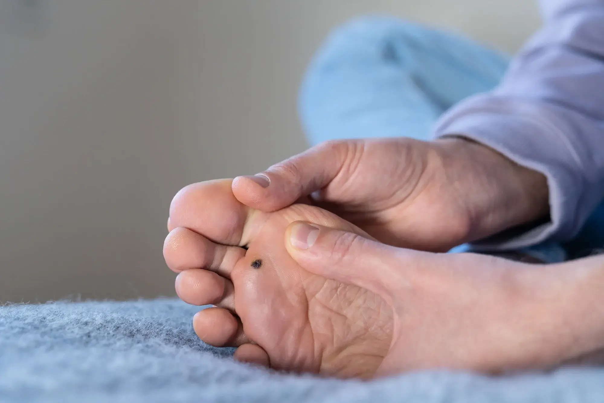 CryoPen treatment for multiple and stubborn Plantar Warts (Verrucae) Coalville, showing safe, precise removal and patient-friendly procedure Coalville