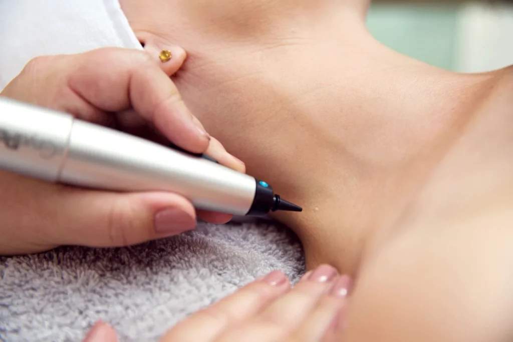 CryoPen precisely treating Molluscum Contagiosum lesions, showing safe and effective removal for faster healing by Cryosonic Coalville