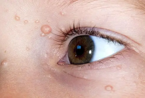 CryoPen treating persistent Molluscum Contagiosum Coalville lesions Coalville