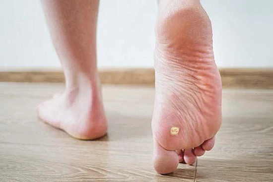 CryoPen treatment removing stubborn Plantar Warts (Verrucae) for precise, safe, and effective relief from resistant lesions Coalville