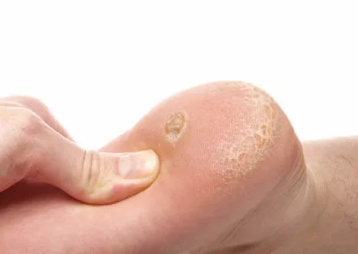 Painful Plantar Warts (Verrucae) Coalville, highlighting how stubborn warts affect everyday activities and comfort Coalville