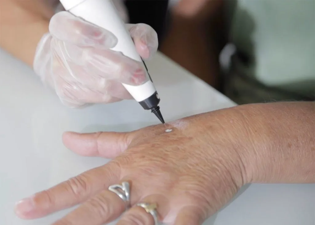 Close-up of CryoPen accuracy Coalville targeting a skin lesion, showing why precision matters for safe and effective removal Coalville