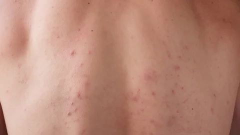 CryoPen treating Coalville Molluscum Contagiosum lesions safely and precisely, illustrating answers to common patient FAQs Coalville